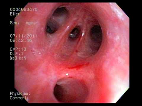 My Bronchoscopy - YouTube