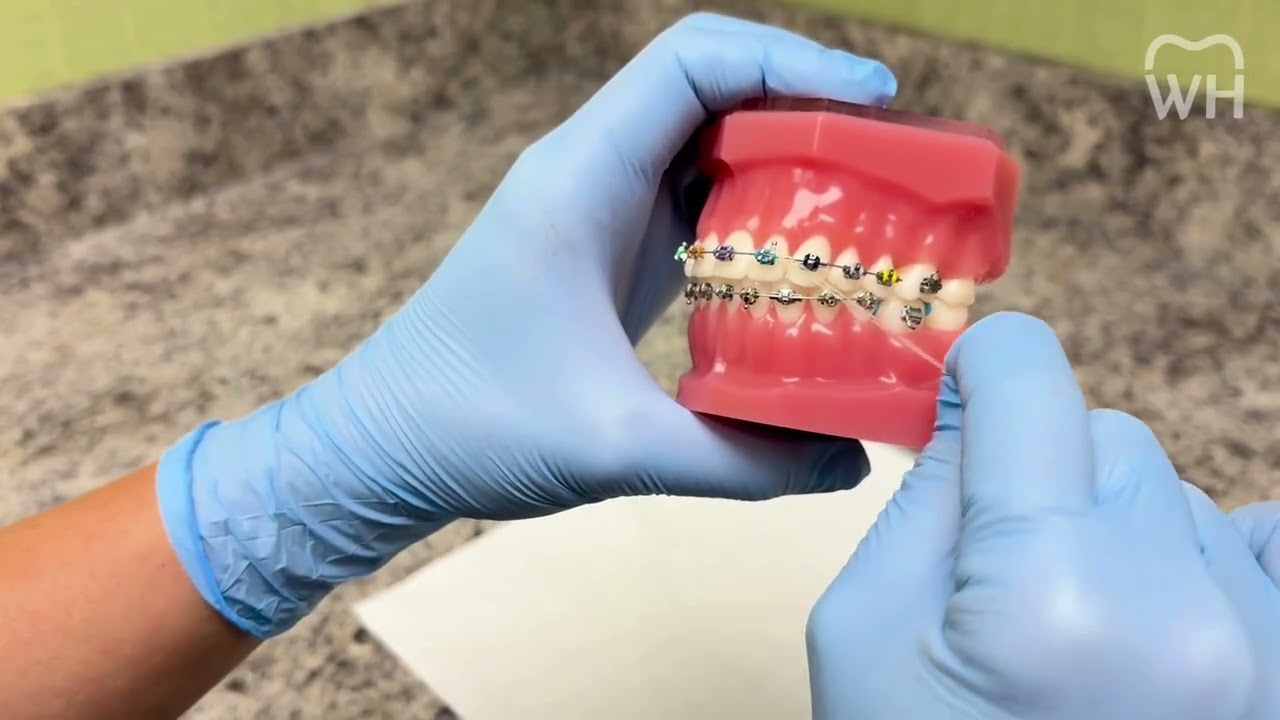 How to Place and Take Out Rubber Bands for Braces - Wilson & Hendrickson Orthodontics