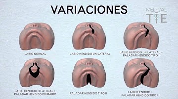 MEJOR VIDEO: LABIO LEPORINO Y PALADAR HENDIDO