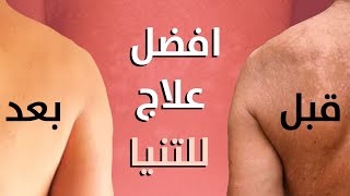 ما هو افضل علاج للتينيا | الأسباب و طرق الوقاية | 2021