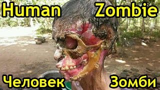 Реальный человек-зомби или некротический фасциит • (Real Human Zombie - Necrotizing Fasciitis)