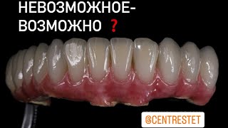 🛑 Балочные цирконовые коронки на имплантантах А2 💥 +7 (495) 568-00-44 🛑 #зубы #имплантациязубов