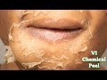 CHEMICAL PEEL Full Process | Procedure | Peeling | Before & After