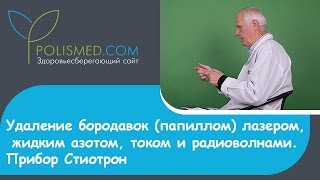 Удаление бородавок (папиллом) лазером, жидким азотом, током и радиоволнами. Прибор Стиотрон(Оглавление: 1. 0:05 Можно ли удалять бородавки (папилломы). 2. 0:38 Больно ли удалять бородавки (папилломы). 3. 1:00..., 2015-12-03T16:57:06.000Z)