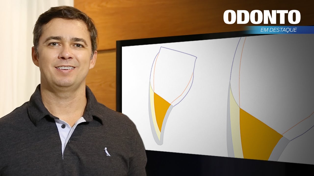 Como evitar que a transição da restauração com o dente fique aparente após o acabamento?