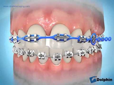 Elastomeric Chain Ligation Colored full arch)