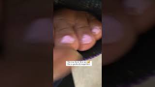 She Was Born With Webbed Toes