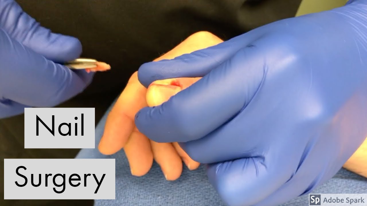 Procedural review of toenail excision