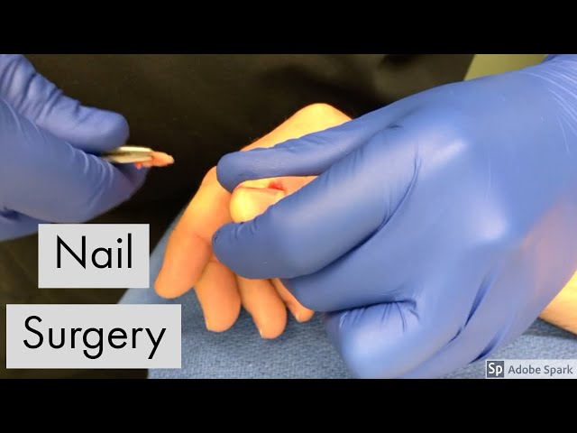 Your Guide To Permanent Toenail Removal