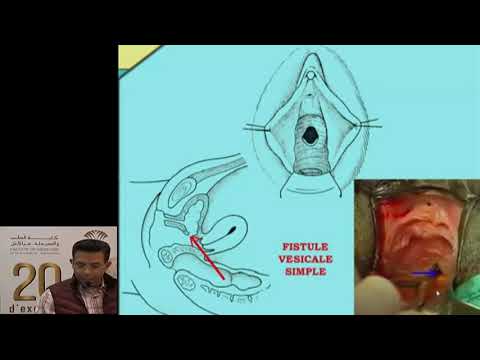 Vidéo: Effets De La Réparation Chirurgicale De La Fistule Obstétricale Sur La Gravité De La Dépression Et De L'anxiété En Éthiopie