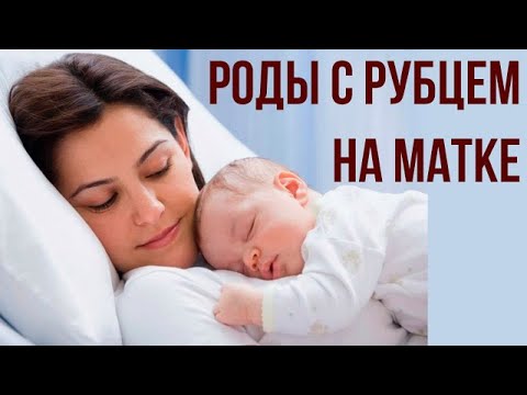 Роды с рубцом на матке. Кесарево сечение