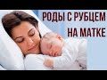 Роды с рубцом на матке. Кесарево сечение