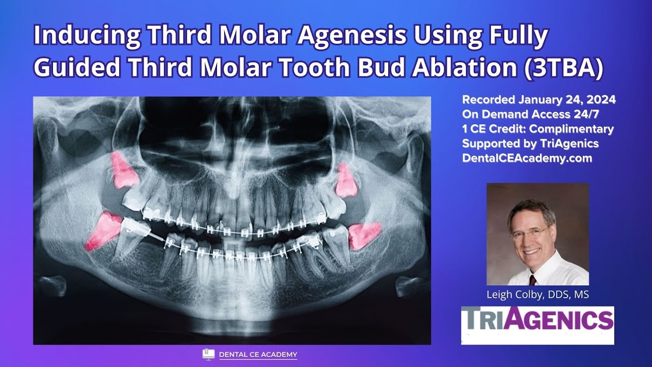 Free Dental CE inar INDUCING THIRD MOLAR AGENESIS USING FULLY GUIDED