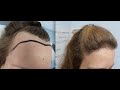 1551 FU's. Hair Transplant by FUE Technique. Female forehead reduction. 1141/2013