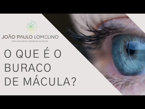 O que é Buraco de Mácula? Dr. João Paulo Lomelino