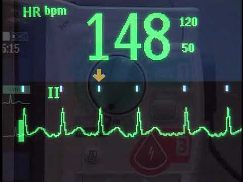 Synchronized Cardioversion with the HeartStart MRx monitor/defibrillator