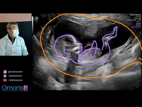 Video: Muutettiinko karhuimplantteja?