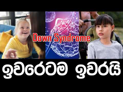 Down Syndrome ඉවරෙටම ඉවරයි