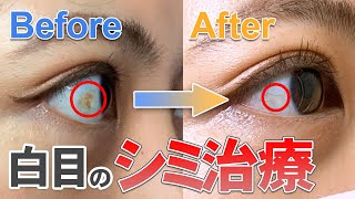 結膜母斑 白目のしみ レーザー治療 池袋の眼科 松原クリニック 結膜母斑 白目のしみ レーザー治療 池袋の眼科 松原クリニック