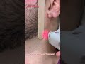 Laser Hair Removal #getsmarthairclub #viralvideo #skincare #beauty