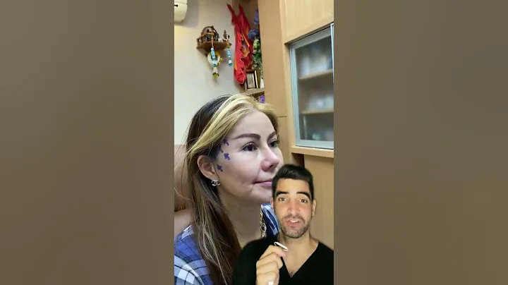 Face Lift Gone Wrong