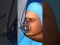 Cervical Disc Replacement Surgery Explained (3D Animation)#cervicaldiscreplacement #spinesurgery #3D
