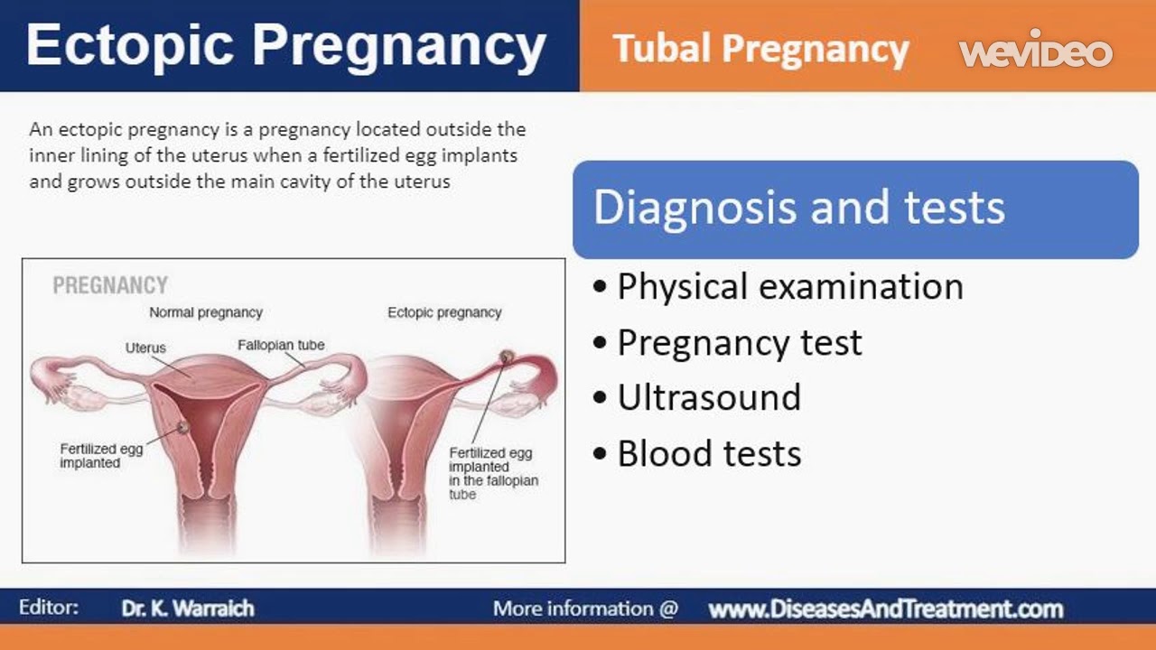 Ectopic pregnancy (Tubal ligation) Diagnosis and tests YouTube