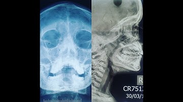 X-RAYS IN E.N.T made easy for 3rd MINOR MBBS & PG RESIDENTS from EXAM perspective