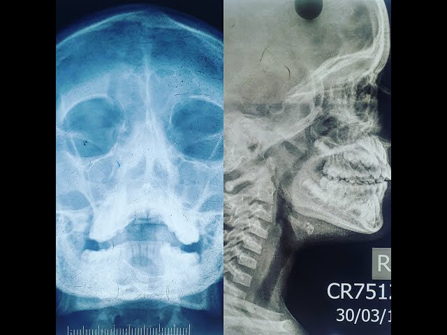 X Rays In Ent Anomaly Detection In Chest X Rays Based On