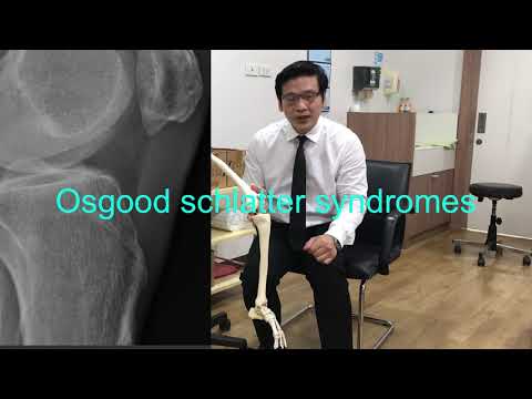 วีดีโอ: 3 วิธีในการจัดการกับโรค Osgood Schlatter