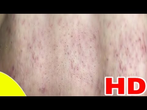 Cystic Acne، Pimples And Blackheads Extraction Treatment On Face !! (PART )