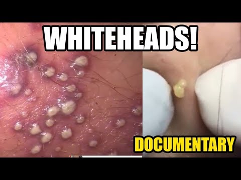 worst-whiteheads,-closed-comedones,-pimples-&-pustules