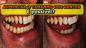 É possível aumentar o tamanho dos dentes?