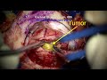Brain surgery: Suboccipital craniotomy for resection of cerebellar metastatic brain tumor.