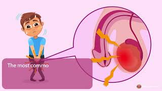 Orchitis – Types, Causes, Signs and Symptoms, Diagnosis & Treatment