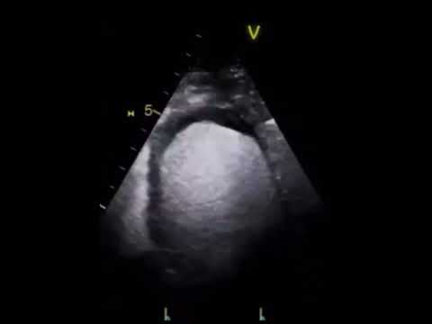 Loeffler's Endocarditis and
