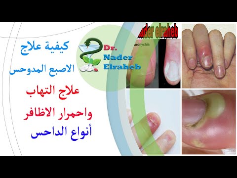 العلاج الفعال لتقيح مرقد الظفر والداحس الظفري في ظوافر القدم والايد اعراض واسباب الداحس 
