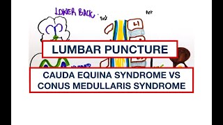 Lower back Anatomy: Lumbar Puncture, Cauda Equina Syndrome vs Conus Medullaris syndrome