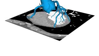 CT Image segmentation and 3D reconstruction