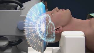 HIFU: Treat without surgery the essential tremor and tremor of Parkinson's disease