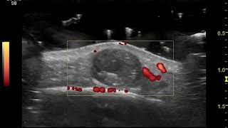 Ecografía Cutánea Pilomatricoma