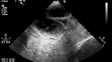TEE: Left atrial appendage thrombus