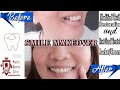 MY DENTAL PROCEDURE: PORCELAIN FUSED TO METAL CROWN🦷- Smile Makeover | Pepito Dental Clinic