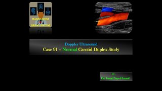 Ultrasound Case 91 -Normal Carotid Duplex Study