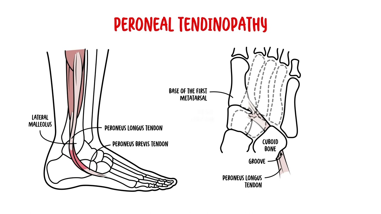 Lateral Ankle Pain YouTube Lateral Ankle Pain YouTube