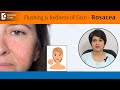When to be worried about Skin Flushing?|Blushing|Flushed Face|Rosacea-Dr.Rasya Dixit|Doctors&#39; Circle