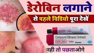 Derobin cream use side effect in Hindi Review || डेरोबिन क्रीम लगाने से पहले जान जाओ नहीं तो पछताओगे