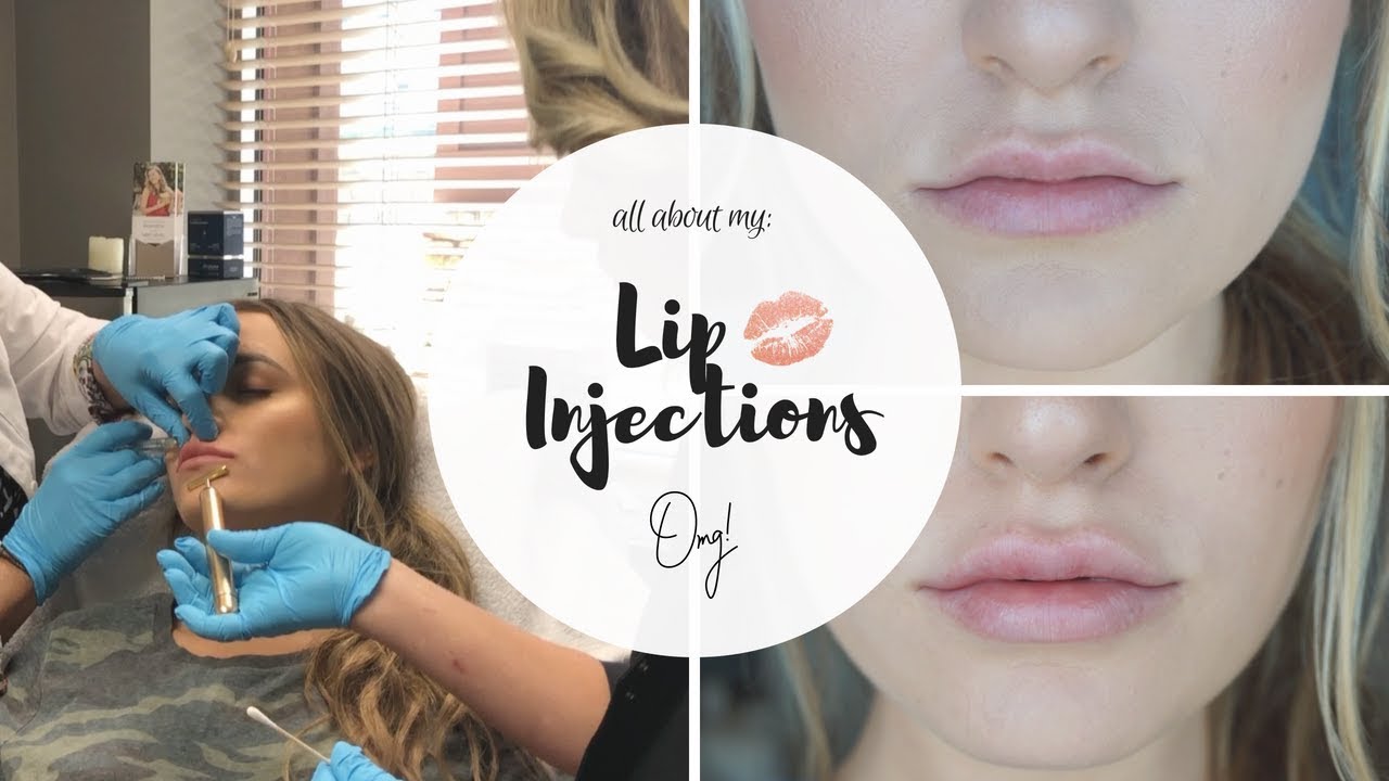 My Experience With Lip Filler! | Urban You Beauty Bar