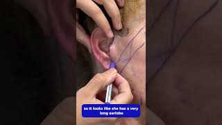 What Is A Pixie Ear After A Facelift And How Do We Fix It? Facelift