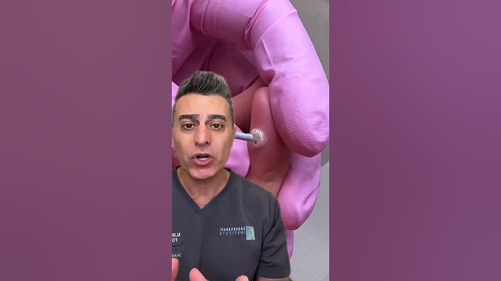 Wart Freezing: The Pros, Cons, and Results